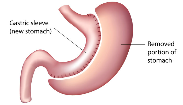 Gastric Sleeve Diagram