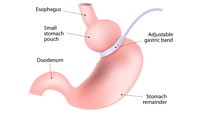 LAP Band Surgery Diagram