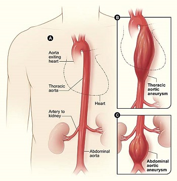 Aortic Aneurysm