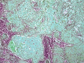 squamous cell carcinoma of the tongue
