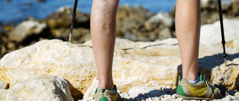 legs of person with vein issues