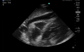Ultrasound