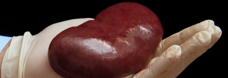 kidney transplant