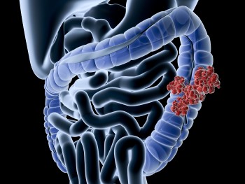 Colon cancer image