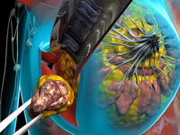 lumpectomy_200x150