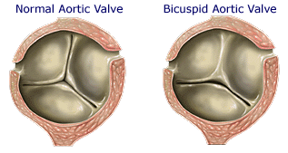 Normal and Biscuspid Aortic Valve