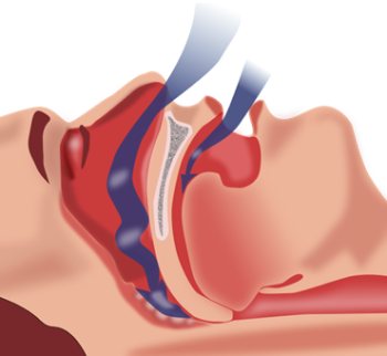 Obstructive Sleep Apnea