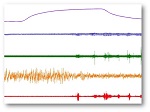 Image Graph of Sleep apnea patterns