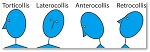 Image Graph of types of dystonia