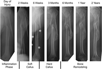 Fracture Healing