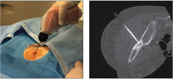 T-guided bone biopsy images in a study optimizing diagnostic yield in sclerotic bone lesions 
