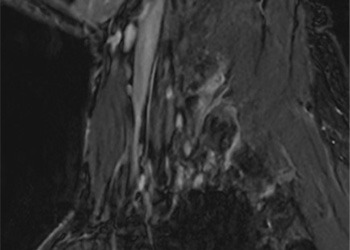 MR neurography image