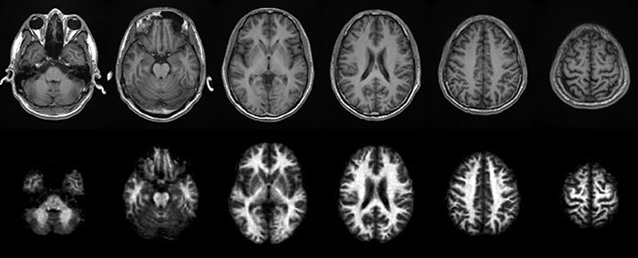 The MTR above T1 weighted anatomic images from a volunteer and corresponding ihMT myelin maps The MTR above T1 weighted anatomic images from a volunteer and corresponding ihMT myelin maps