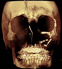 3D craniofacial plastics