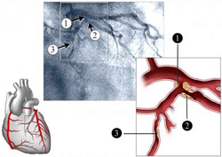Angiography