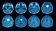 Neuroradiology