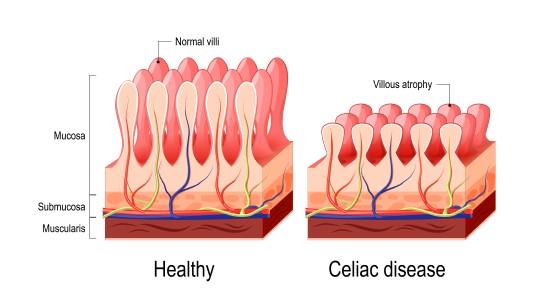 Medical Celiac