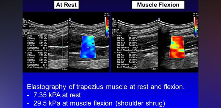 Elastrography of trapezius muscle