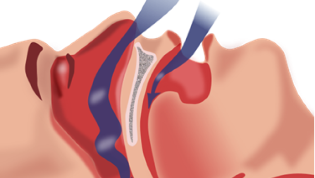 Obstructive Sleep Apnea