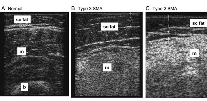 Transverse ultrasound images from quadriceps