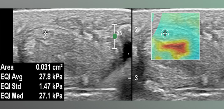 Ultrasound elastography visual of muscle