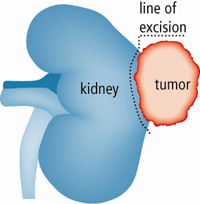 Laprenalnephrectomy